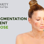 Hyperpigmentation Treatment in San Jose