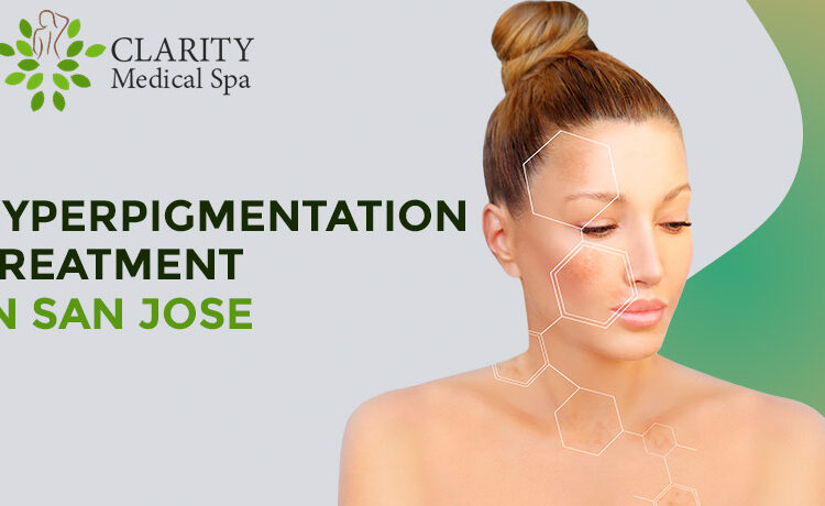 hyperpigmentationAt Clarity Medical Spa, in San Jose