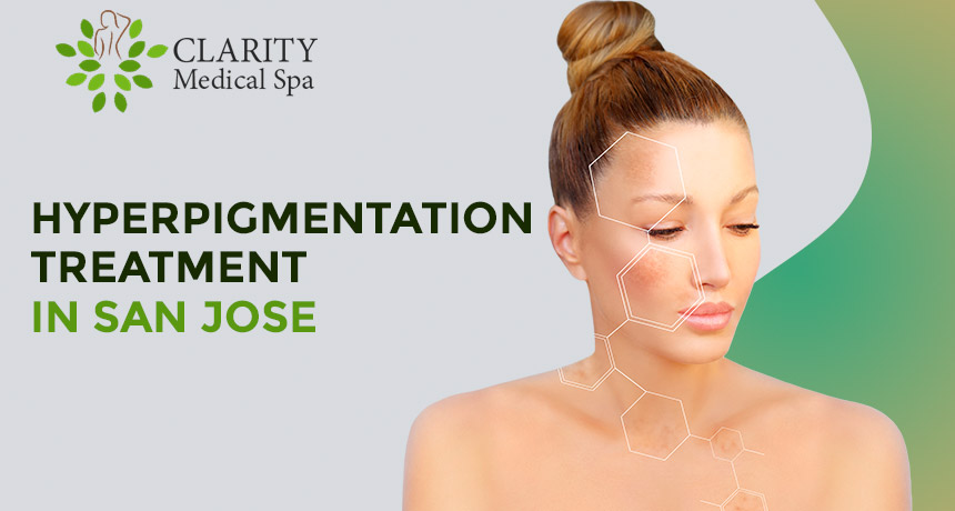 hyperpigmentationAt Clarity Medical Spa, in San Jose