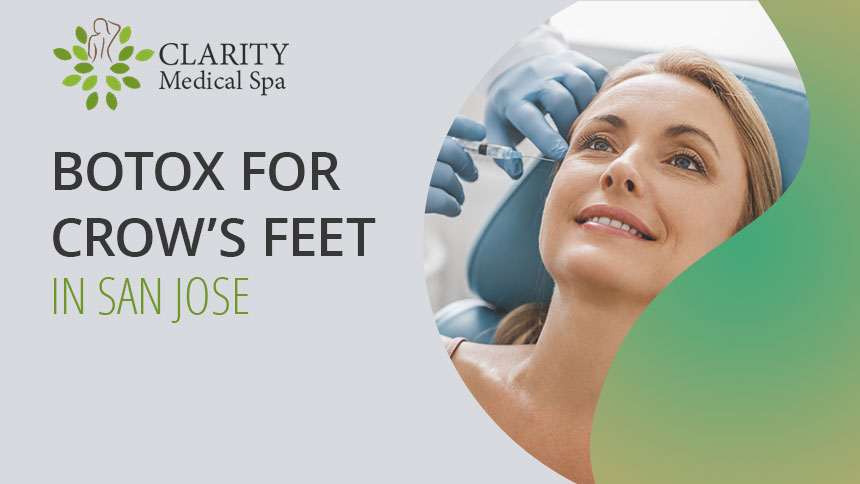 Botox for crows feet in San Jose