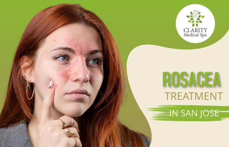 Rosacea treatment in San Jose