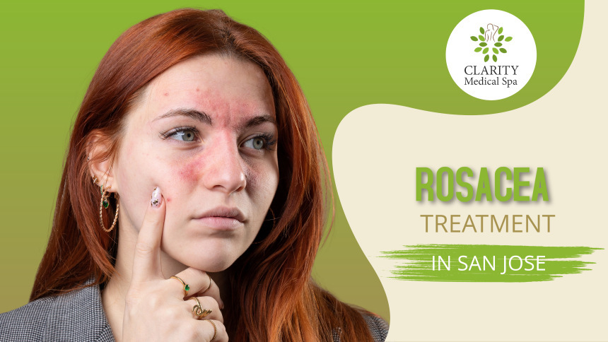 Rosacea treatment in San Jose