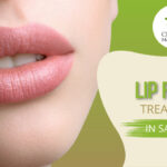 Lip Fillers in San Jose