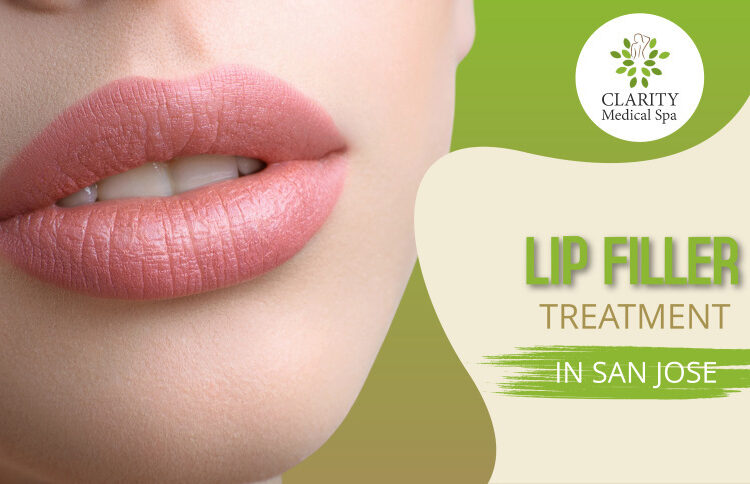 Lip Fillers in San Jose