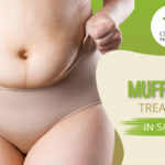 Muffin Top Treatment in San Jose